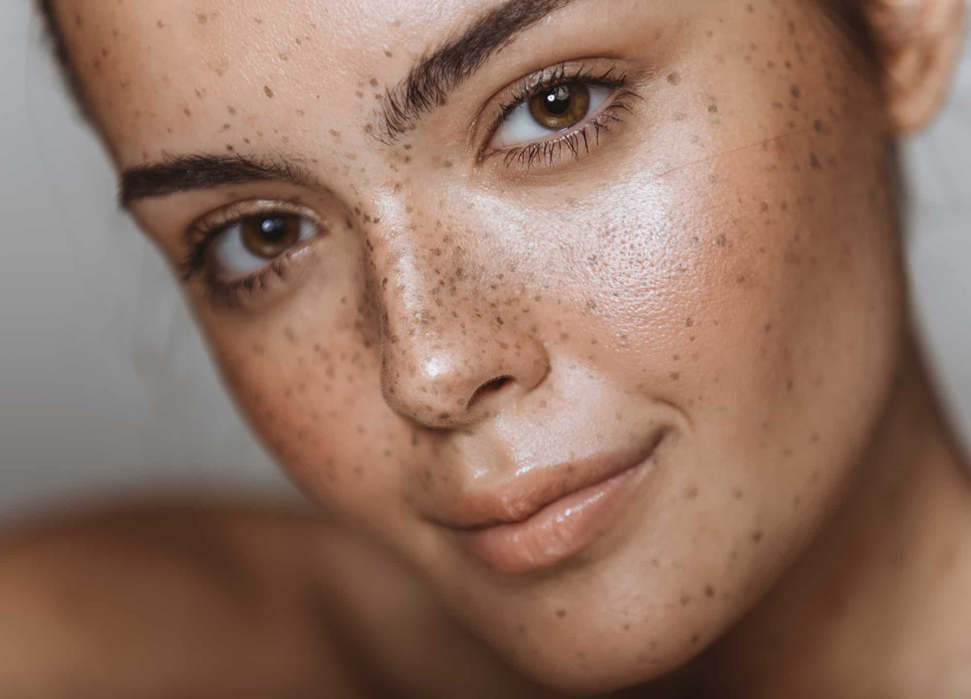 Hyperpigmentation: How 5 Skin Experts Treat Their Own Sun-Related Skin