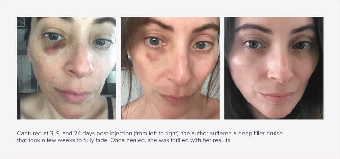 How to Cover Bruises from Filler Injections | RealSelf News