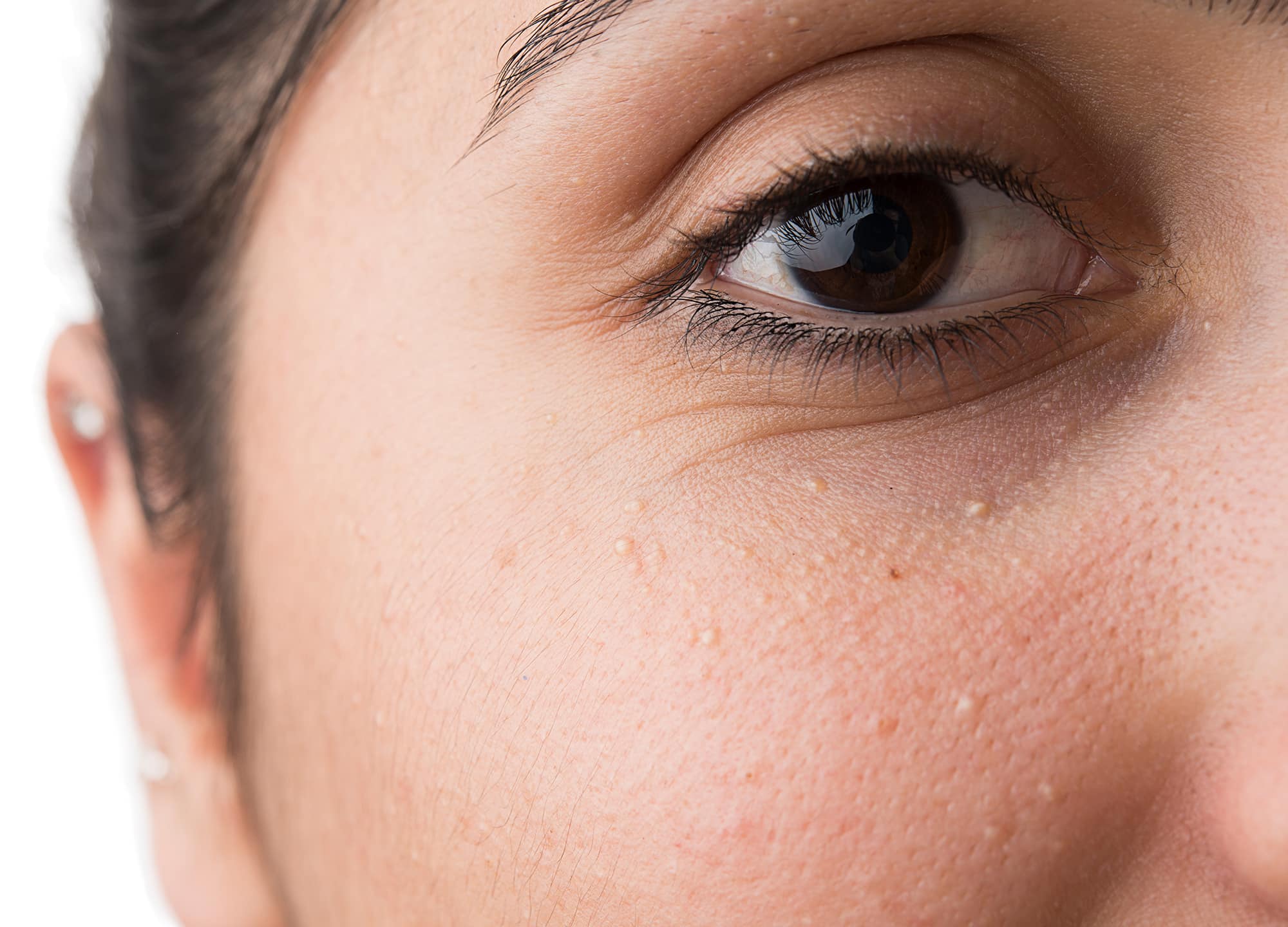 Red Bumps Under The Eyes: Causes and Effective Treatments