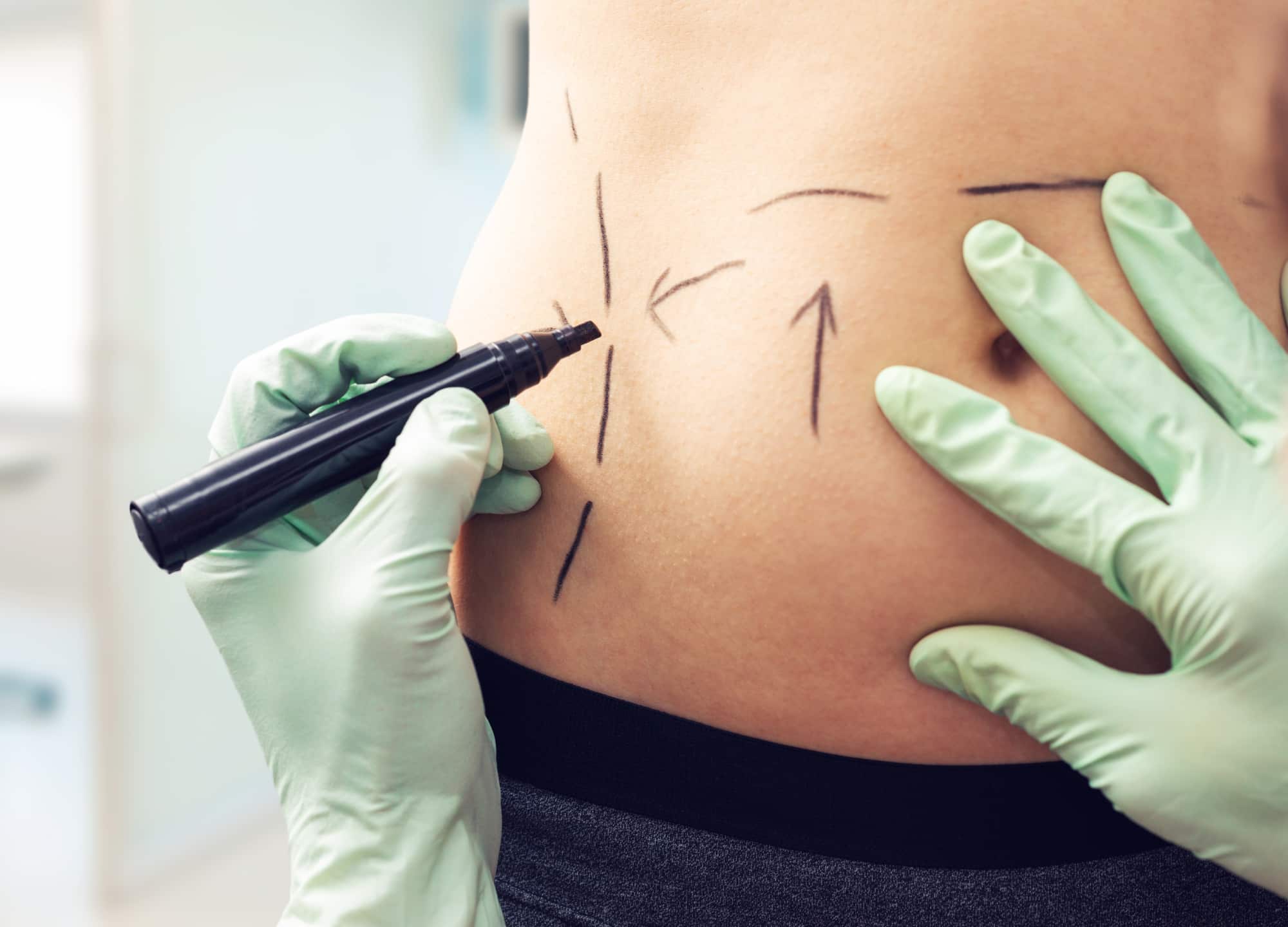 Tummy Tuck or Liposuction: What's the Difference?