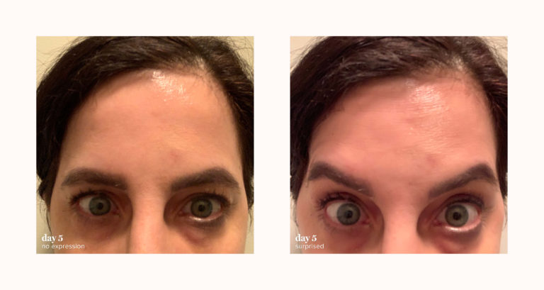 Jeuveau vs. Botox: What’s the Difference? | RealSelf News