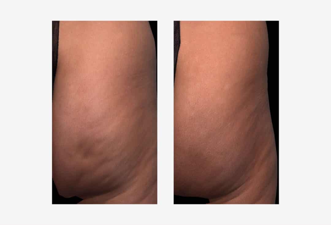 What You Need to Know About Qwo-Cellulite Injectable | RealSelf News