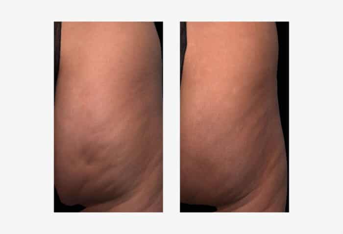 Qwo Cellulite Injections—Does It Actually Work?