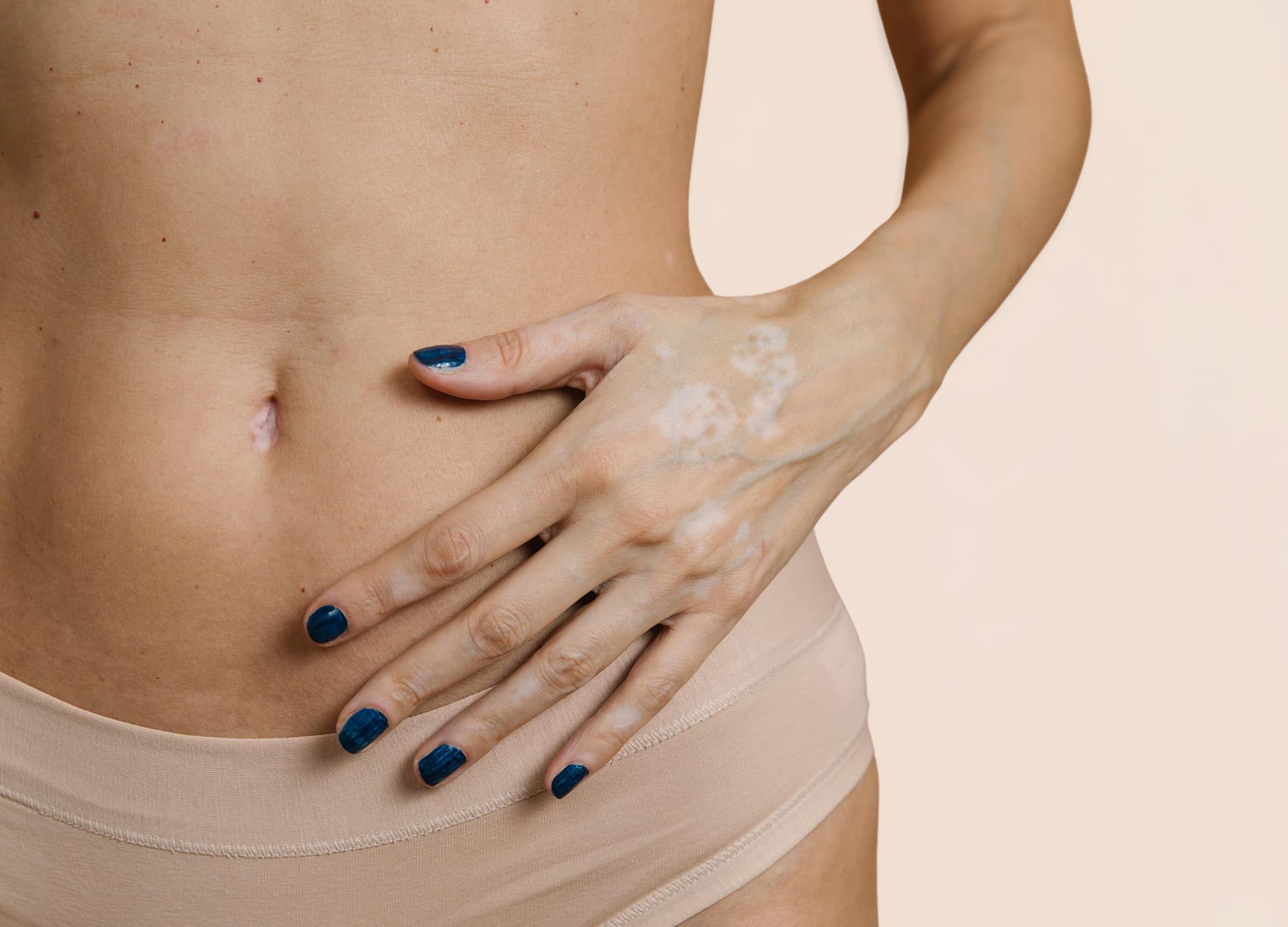 8 Things You Should Know About A Tummy Tuck—From Someone Who Got One