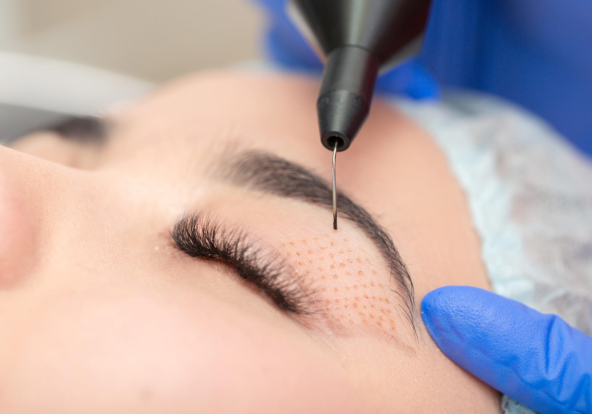 Want an Eye Lift Without Surgery? Here's How
