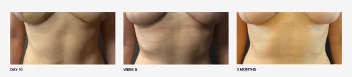 breast lift before and after scars
