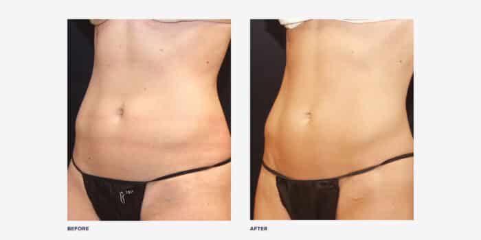 Hi-Def Lipo and Ab Etching: Should You Get It?