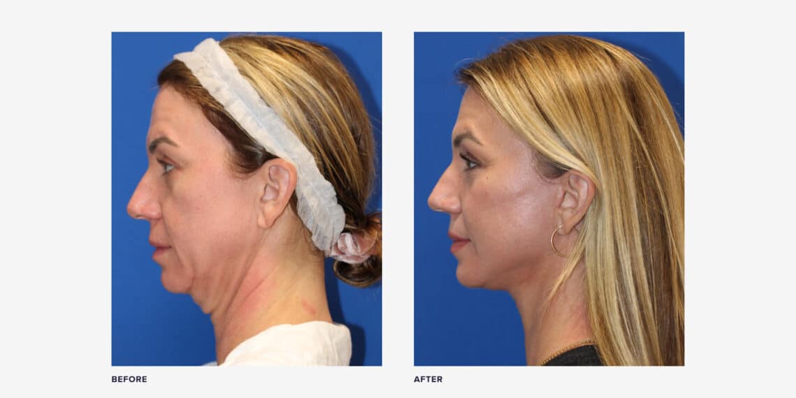 4 Things To Look For In Neck Lift Before And After Photos Realself News