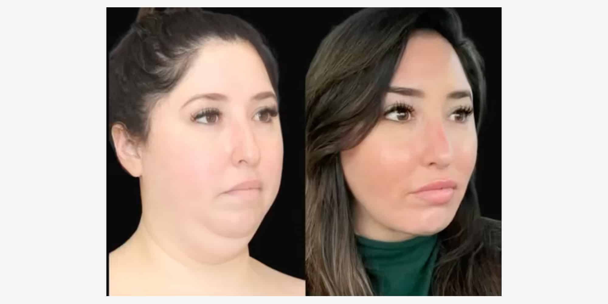 4 Signs of Good Buccal Fat Removal Results RealSelf News