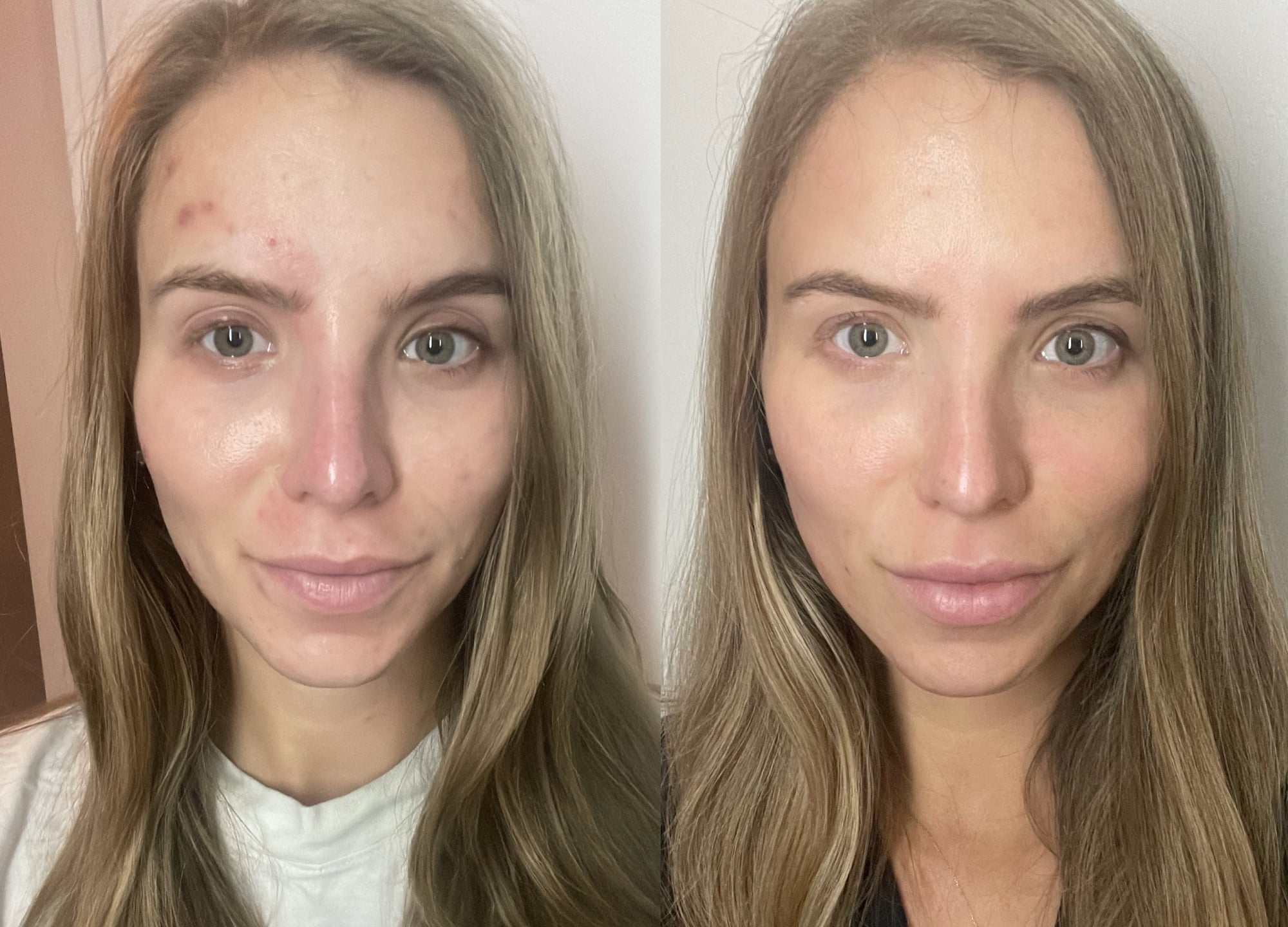 accutane before during and after