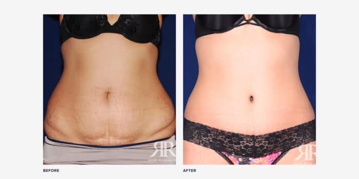 Top 10 Best Tummy Tuck Before and Afters