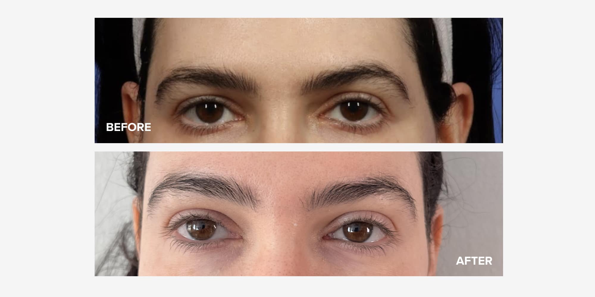 Brow Lift Before After Photos And What It Felt Like Realself News