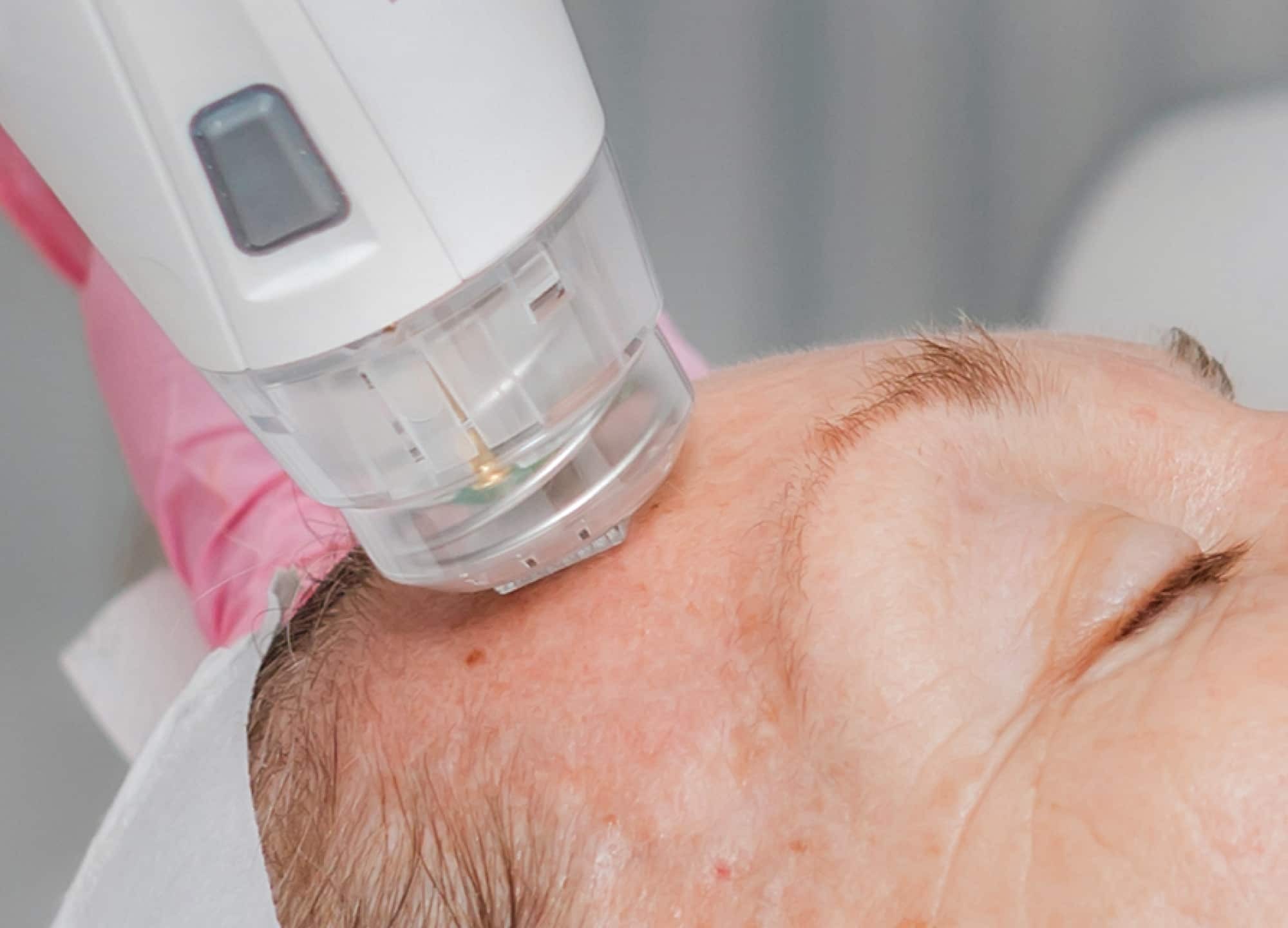 7 Questions to Ask Before RF Microneedling RealSelf News