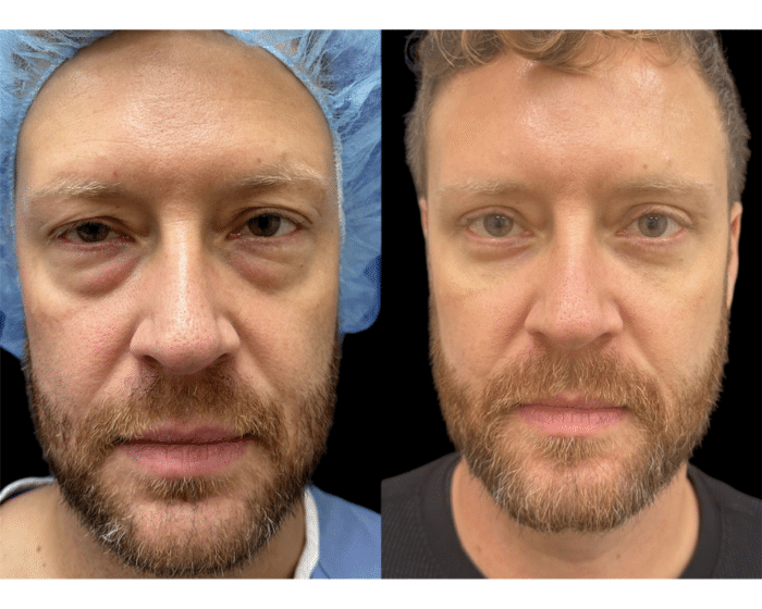 Lower eyelid surgery before and after